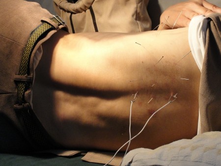 acupuncture contre l'insomnie