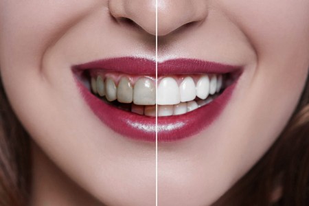 blanchiment des dents