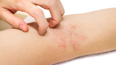 lésions eczémas