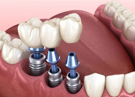 implants dentaires