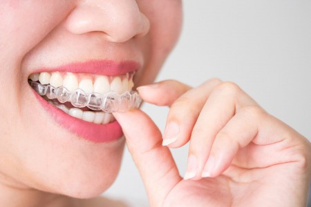 Invisalign