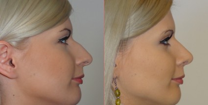 rhinoplastie avant apres