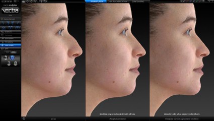 simulation 3D chirurgie nez